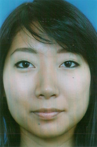 Asian Ethnic Rhinoplasty after 1261888