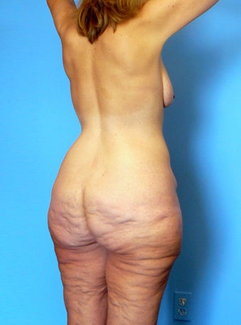 High-Definition™ Total Body Lift 177431
