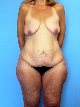 High-Definition™ Total Body Lift before 177431