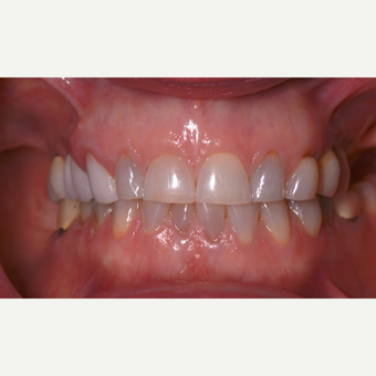 45-54 year old woman treated with All on 4 Full Arch Dental Implants before 3303611