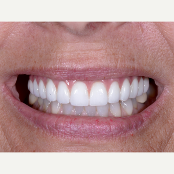 45-54 year old woman treated with All on 4 Full Arch Dental Implants after 3303611