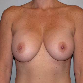35-44 year old woman treated with Breast Augmentation after 3147657