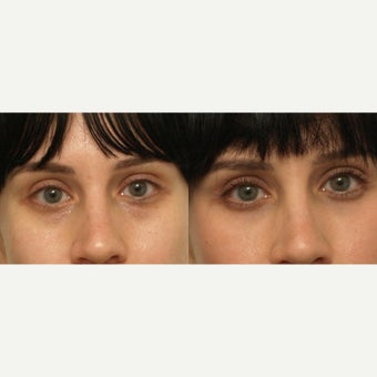 25-34 year old woman treated with Restylane and Latisse before 1568888