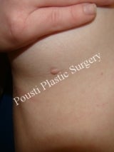 Nipple-areola Repair before 1507652