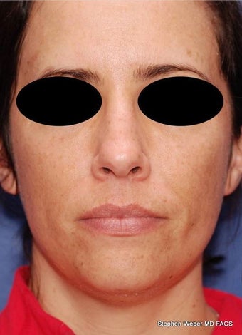 25-34 year old woman treated with Rhinoplasty before 3624175