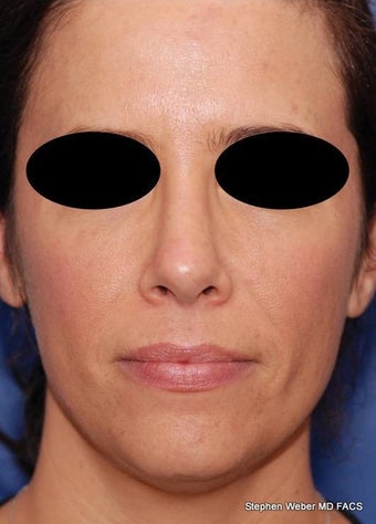 25-34 year old woman treated with Rhinoplasty after 3624175
