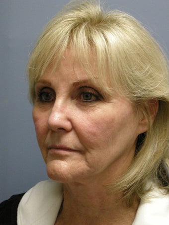 Chin Augmentation 731941