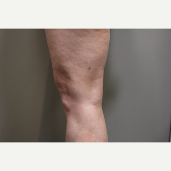 45-54 year old woman treated with Smart Lipo Precision to the Knees before 3706296