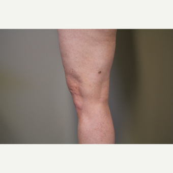 45-54 year old woman treated with Smart Lipo Precision to the Knees after 3706296