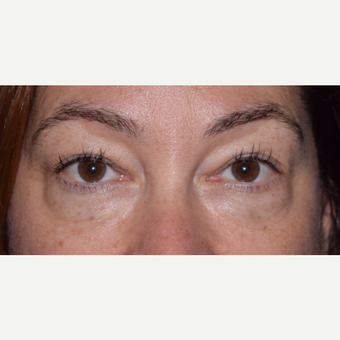 45-54 year old woman treated for Eye Bags with Blepharoplasty & Laser before 3649210