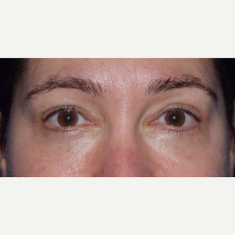 45-54 year old woman treated for Eye Bags with Blepharoplasty & Laser after 3649210