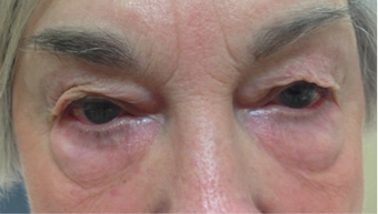 72 year old woman treated with Eye Bags Treatment before 3367458