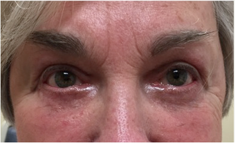 72 year old woman treated with Eye Bags Treatment after 3367458