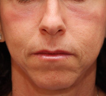 Fraxel Repair for Under-Eye Resurfacing after 68013