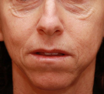 Fraxel Repair for Under-Eye Resurfacing before 68013