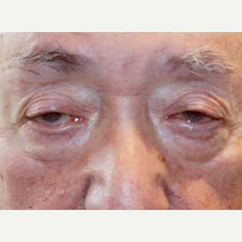 55-64 year old man treated with Drop-and-LIft before 3377129