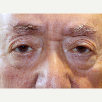55-64 year old man treated with Drop-and-LIft after 3377129
