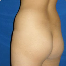 25-34 year old woman treated with Brazilian Butt Lift withLiposuction before 3374898