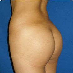25-34 year old woman treated with Brazilian Butt Lift withLiposuction after 3374898