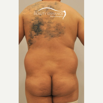 Liposuction before 3377535