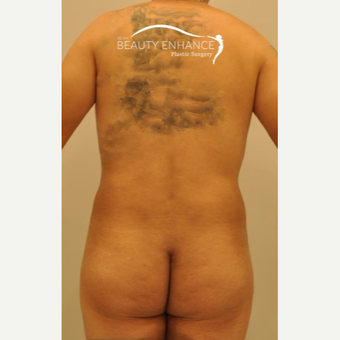 Liposuction after 3377535