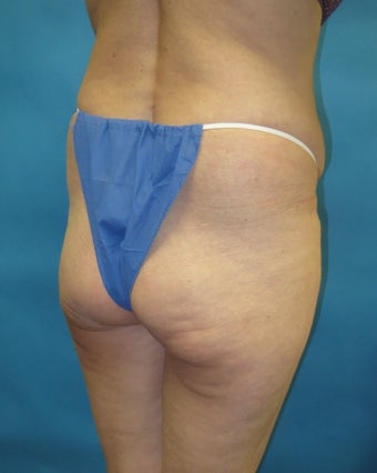 Butt augmentation Revision before 1420338