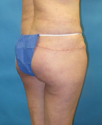 Butt augmentation Revision after 1420338