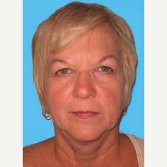 Facelift before 3824953