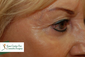 45-54 year old woman treated with Botox after 1630511