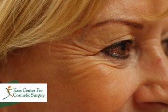 45-54 year old woman treated with Botox before 1630511