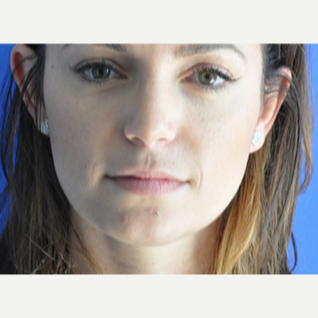 25-34 year old woman treated with Lip Augmentation before 3240343