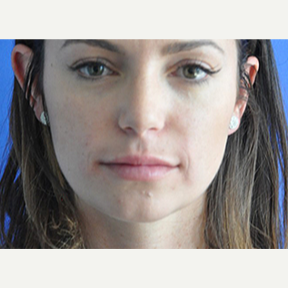 25-34 year old woman treated with Lip Augmentation after 3240343