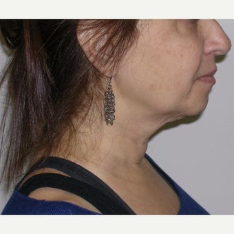 55-64 year old woman treated with Kybella after 2651770