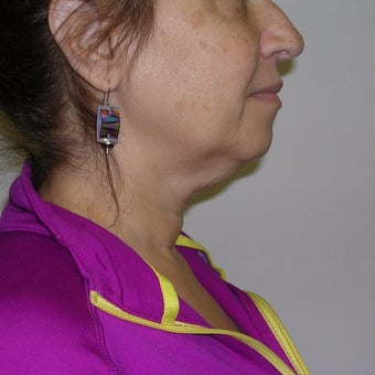 55-64 year old woman treated with Kybella before 2651770