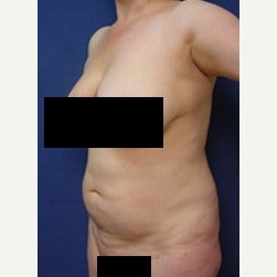45-54 year old woman treated with Mini Tummy Tuck before 2058406