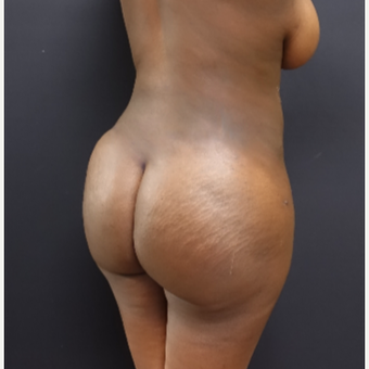 25-34 year old woman treated with Liposuction after 3363920