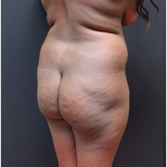 25-34 year old woman treated with Liposuction before 3363920