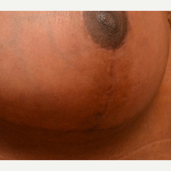 Embrace Scar Therapy used on secondary breast reduction patient after 3241692