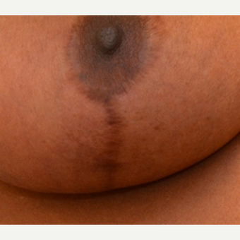 Embrace Scar Therapy used on secondary breast reduction patient before 3241692