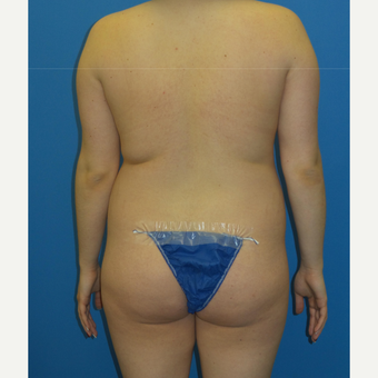 18-24 year old woman treated with Brazilian Butt Lift before 3341379