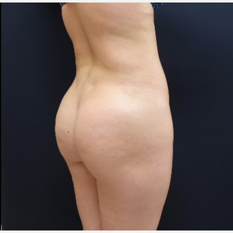 25-34 year old woman treated with Butt Augmentation using 712cc Round Silicone Butt Implants before 3259513
