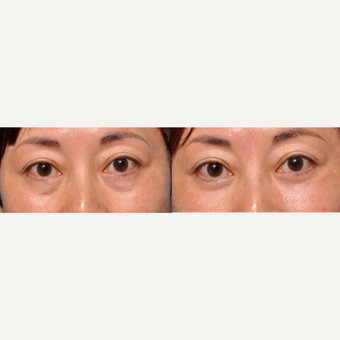Tear trough / eye bags treated with permanent fix - lower lid blepharoplasty with fat transposition before 2755634