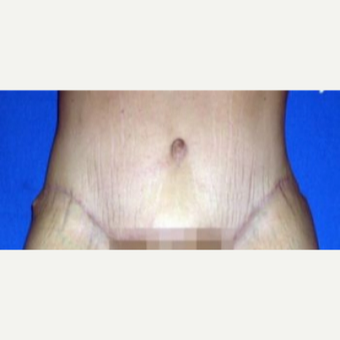 25-34 year old woman treated with Tummy Tuck after 3009815