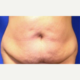 25-34 year old woman treated with Tummy Tuck before 3009815