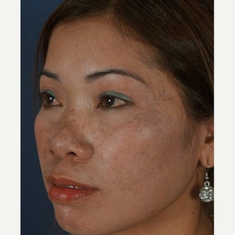 35-44 year old woman treated with Non Surgical Nose Job before 2074336