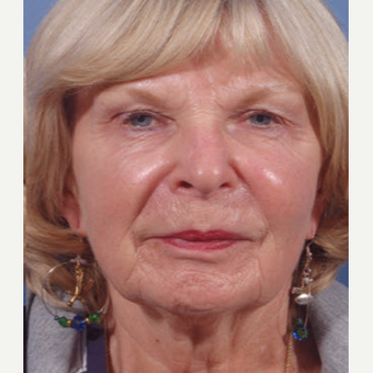 65-74 year old woman treated with Restylane after 3725330