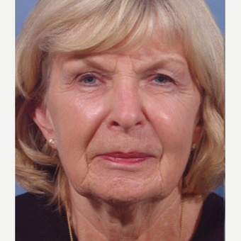 65-74 year old woman treated with Restylane before 3725330