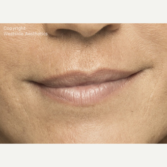 Belotero for Nasolabial Folds after 2988830