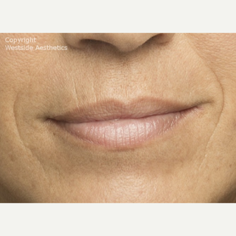 Belotero for Nasolabial Folds before 2988830