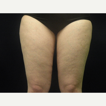 18-24 year old woman treated with CoolSculpting after 3680260